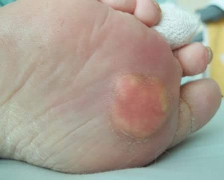 Painful lump in ball of foot, poron xrd insoles