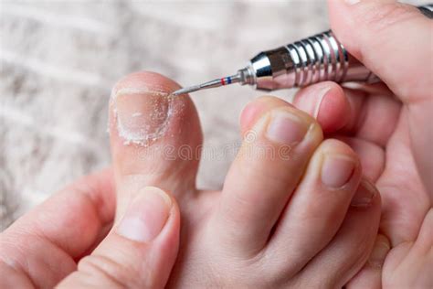 Hardware Pedicure for Yourself, Ingrown Toenail, Chiropody and Podology ...