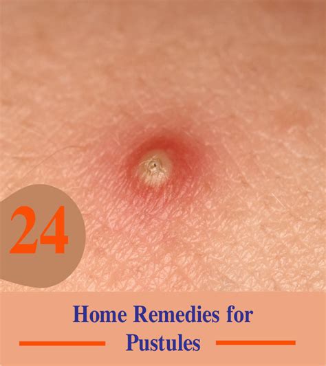 home remedies  pustules promohealthy