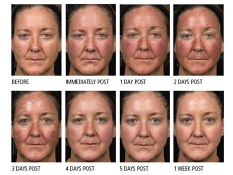 Laser To Remove Dark Spots On Face