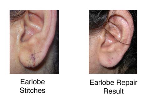 Ear Lobe Repair - Dr. Nina Madnani