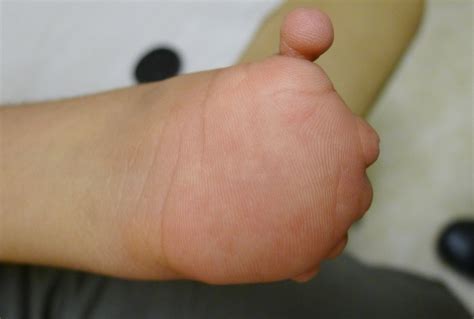 Congenital Amputation New York City | Congenital Hand Differences New ...