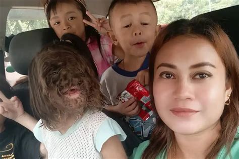 The Story of Malaysia's First Toddler with Werewolf Syndrome - Medical ...