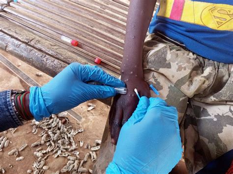 mpox ihr emergency committee