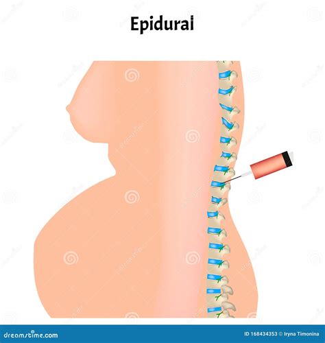Epidural Anesthesia during Childbirth. Epidural Anesthesia of Pregnant