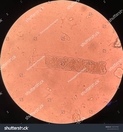 Cells Urine Sediment: Over 3 Royalty-Free Licensable Stock