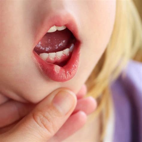6 Remedies to Combat Cold Sores in Children - Step To Health