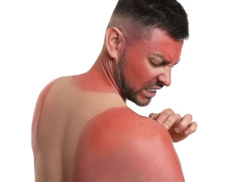 stop sunburn itch center  medical