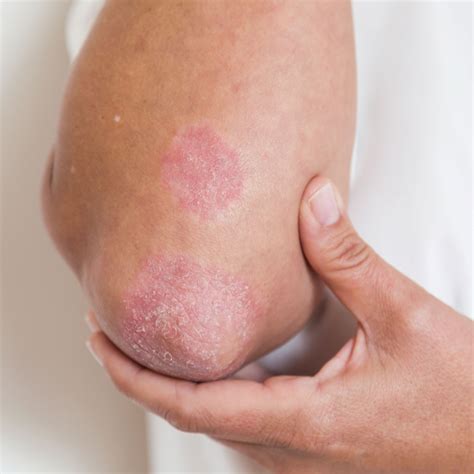 What Is Psoriasis? | psoriasisSPEAKS