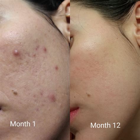 Low dose accutane progress! : r/acne