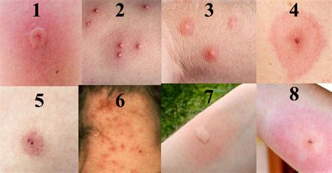 trick  recognize      common bug bites