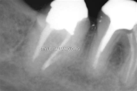 Removal of an Anatomic Post and Core A Case Report - Style Italiano