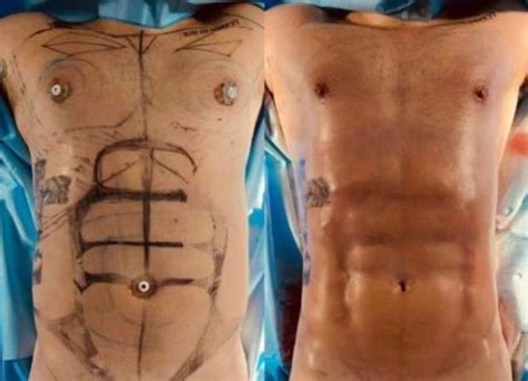 Ex-BBB21 Caio Afiune faz lipo LAD; confira o antes e depois