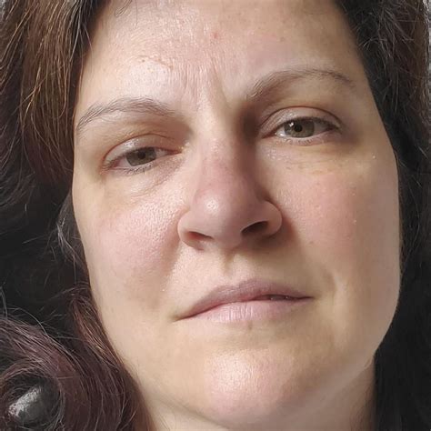 Forehead Bleeding Blood Clots This Is The Face Of Someone Exhausted