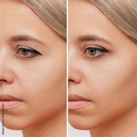 Close up of a young caucasian woman's face with drooping upper eyelid ...