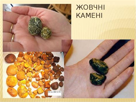 Жовчнокам'яна хвороба