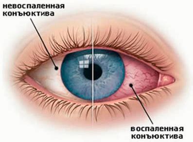 Конъюнктивит: симптомы, формы, причины развития, диагностика, лечение ...