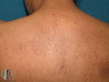 Amyloidosis Skin