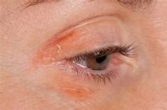 Eczema Face Treatment Tips – Best Eczema Remedy