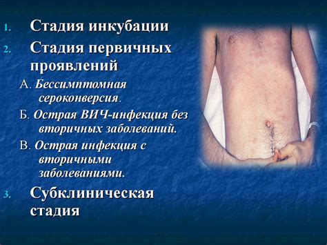 ВИЧ-инфекция. Постконтактная профилактика вич-инфекции у мед.работников ...