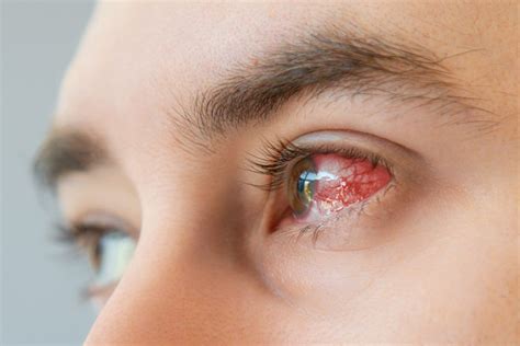 dry eye disease alters   eyes cornea heals   injury