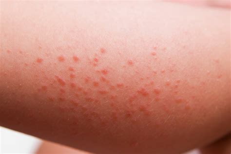 Celiac disease rash dermatitis herpetiformis explained – Artofit