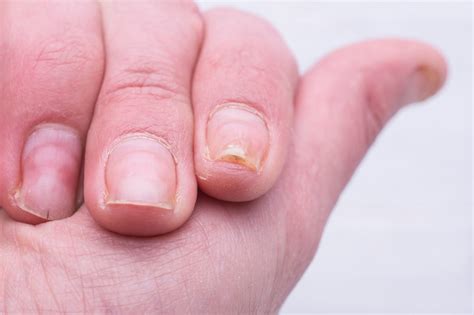 Psoriatic Nail Dystrophy Associated With Erosive Damage at DIP Joints ...