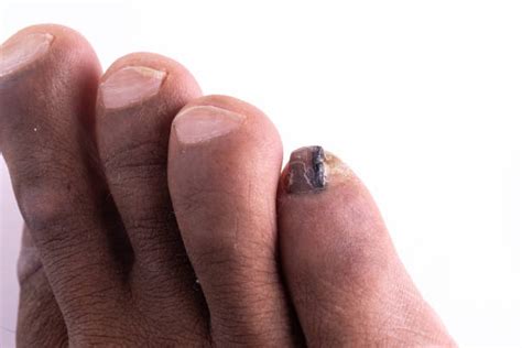 200+ Tinea Unguium Stock Photos, Pictures & Royalty-Free Images - iStock