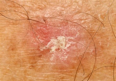 sun damaged skin actinic keratosis specialist  nw dc