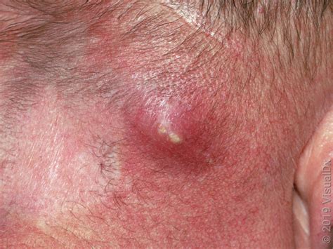 Is It Safe to Drain an Abscess at Home? - GoodRx