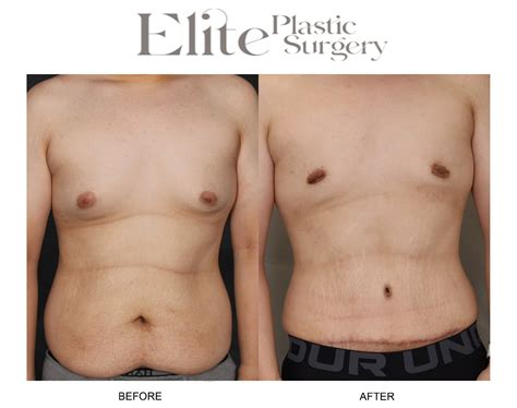 Abdominoplasty (Tummy Tuck) Before & After Photos | Elite Plastic Surgery