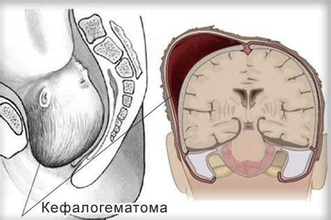 Лечение кефалогематомы в Израиле