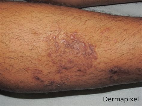 liquen simple causas sintomas  tratamiento doctor