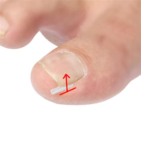 Ingrown Toenail Corrector Strips Curved Toenail Corrector Foot Care