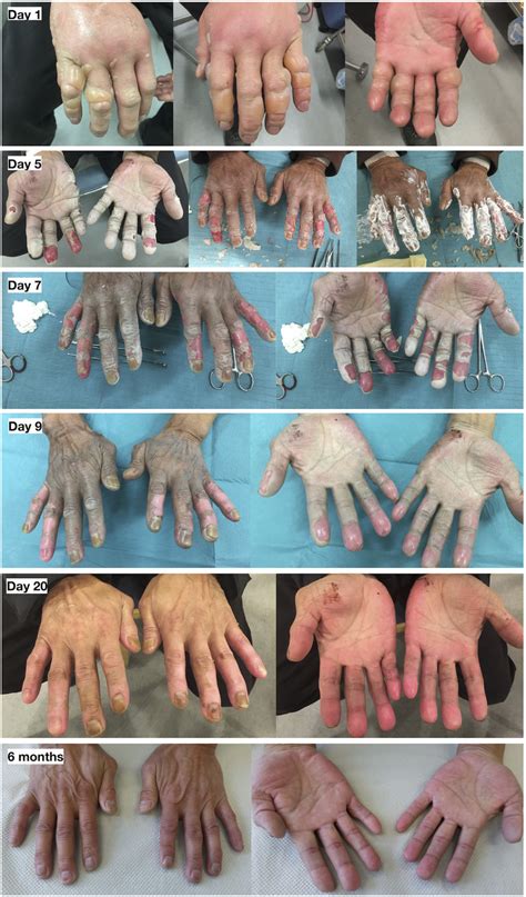 Case 5-Frostbite on both hands during Arctic storm, Qaanaaq. Second-or ...