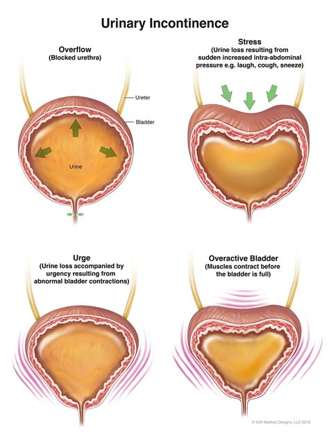 urinary incontinence types  symptoms  treatment