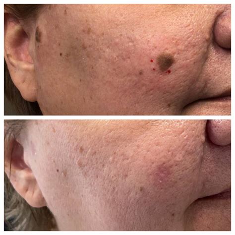 seborrheic keratosis removal    st louis dermatology