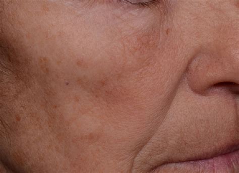 Sederma introduces Matrixyl Morphomics: COSSMA
