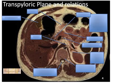 diagram   transpyloric plane  relations quizlet