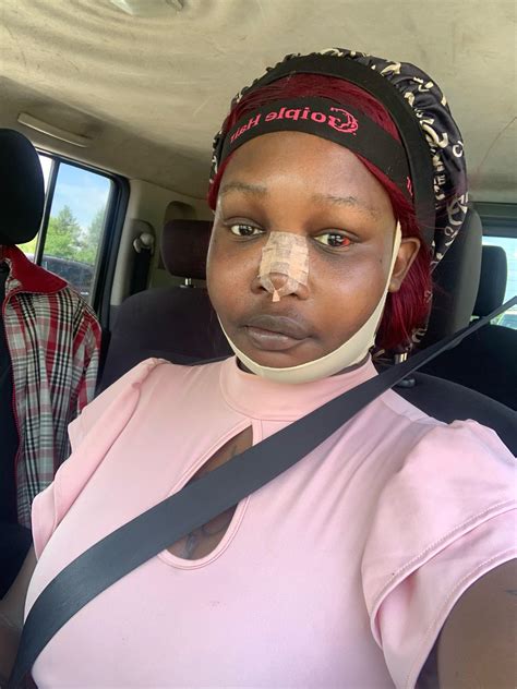 One week post facial feminization surgery : r/Transgender_Surgeries