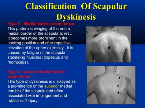 Rotatory cuff syndrome & Scapular Dyskinesia