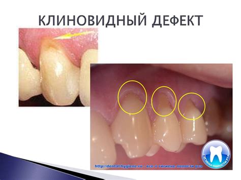 Некариозные поражения зубов - презентация онлайн