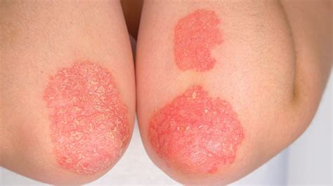 8 everyday strategies to help prevent psoriasis flare-ups - Sharecare