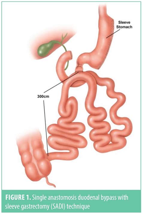 leaks  single anastomosis duodenoileal bypass  sleeve