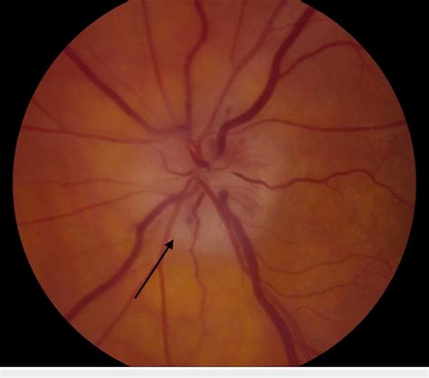 Optic Disc Pallor Causes at Valerie Robinson blog
