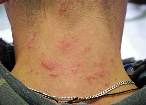 Angioedema
