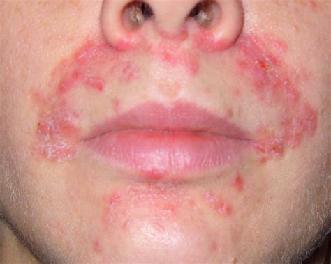 Perioral Dermatitis Colloidal Silver at Gail Carroll blog