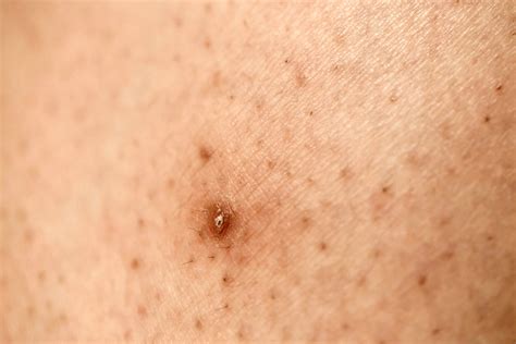 Ingrown hair - what should you do to prevent them so they don't trigge ...