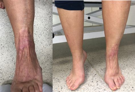 Necrotizing Fasciitis Progression
