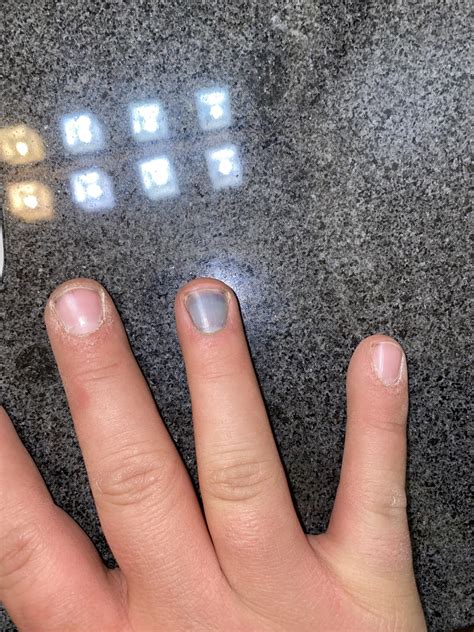 Pinched finger : r/medical